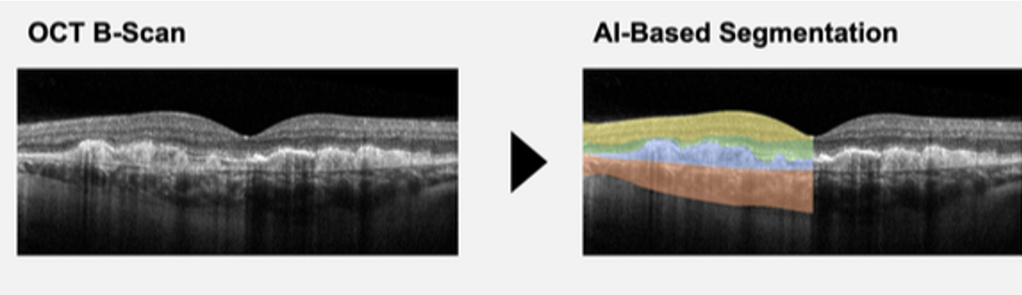 OCT B-scan with AI-based segmentation